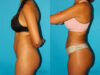 Brazilian Butt Lift case #4765 slider thumbnail
