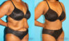 Post Bariatric Surgery (Massive Weight Loss) case #6779 slider thumbnail