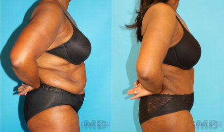 Post Bariatric Surgery (Massive Weight Loss) case #6779