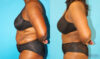 Post Bariatric Surgery (Massive Weight Loss) case #6779 slider thumbnail