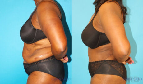 Post Bariatric Surgery (Massive Weight Loss) case #6779