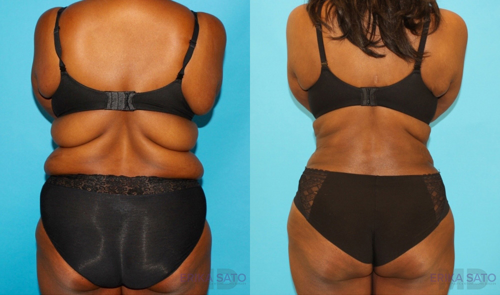 Post Bariatric Surgery (Massive Weight Loss) case #6779