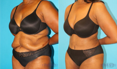 Post Bariatric Surgery (Massive Weight Loss) case #6779