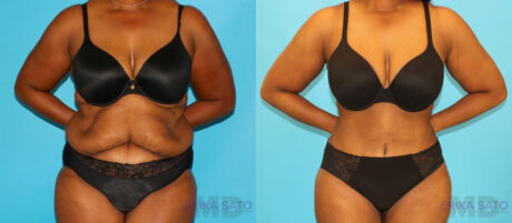 Post Bariatric Surgery (Massive Weight Loss) case #6779