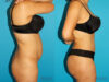 Tummy Tuck case #7340 slider thumbnail