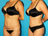 Tummy Tuck case #7340 slider thumbnail