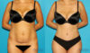 Tummy Tuck case #7340 slider thumbnail