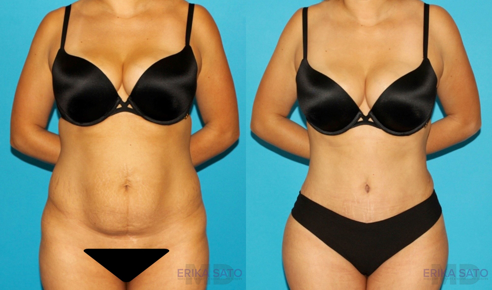 Tummy Tuck case #7340