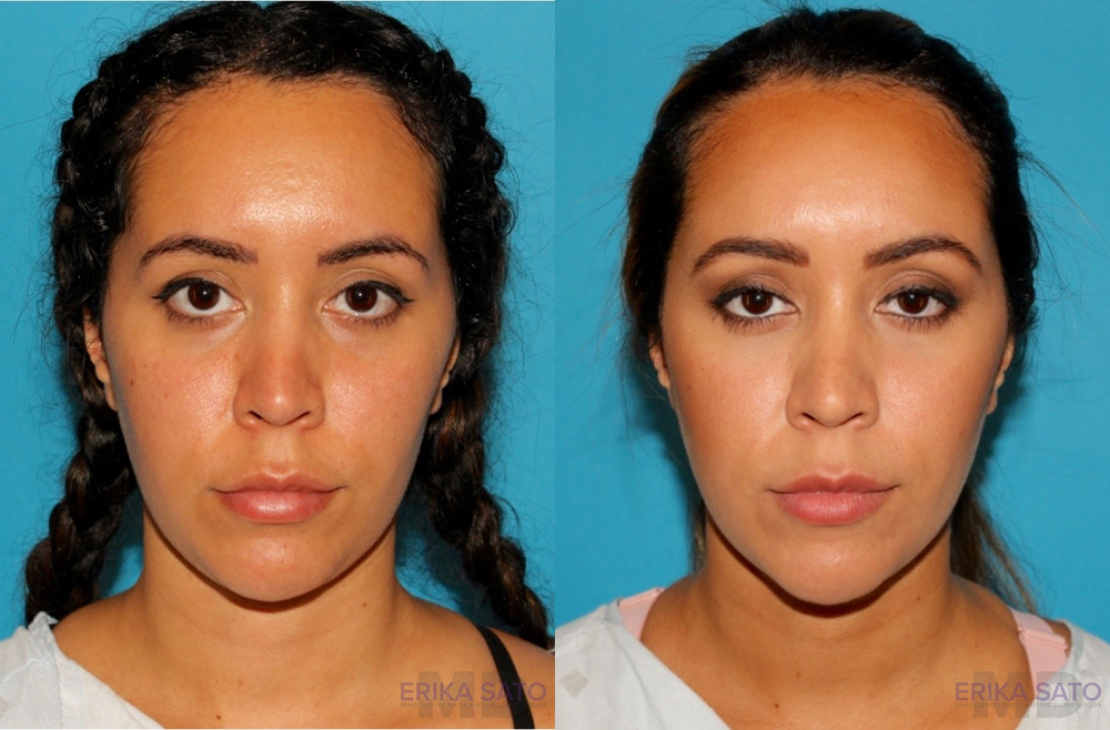 Submental Liposuction case #6943