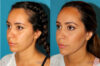 Submental Liposuction case #6943 slider thumbnail