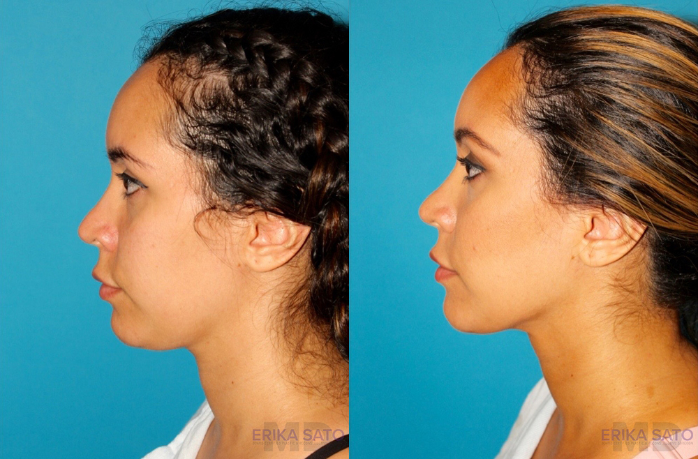 Submental Liposuction case #6943