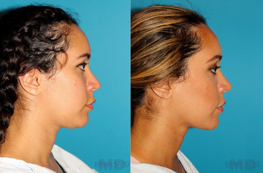 Submental Liposuction case #6943