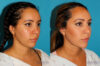 Submental Liposuction case #6943 slider thumbnail