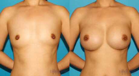 Breast Augmentation case #6250