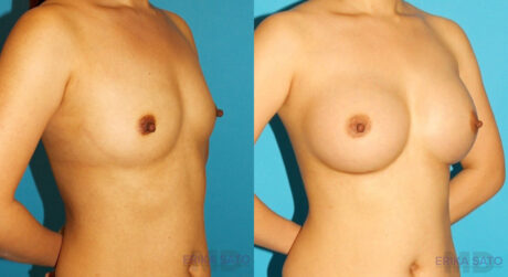 Breast Augmentation case #6250