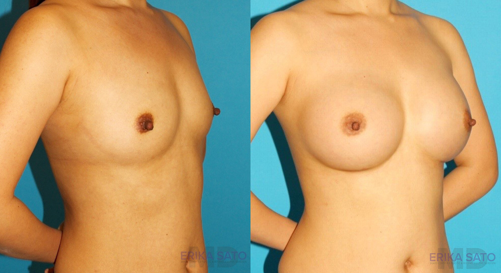 Breast Augmentation case #6250