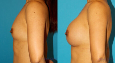 Breast Augmentation case #6250