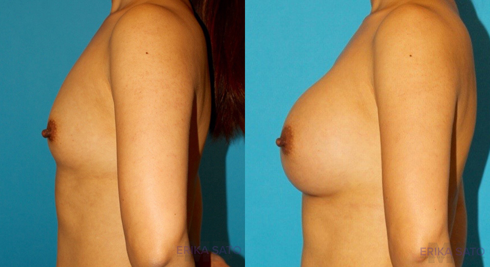 Breast Augmentation case #6250
