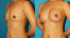 Breast Augmentation case #6250 slider thumbnail