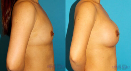 Breast Augmentation case #6250