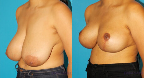 Breast Reduction case #7962