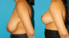 Breast Reduction case #7962 slider thumbnail
