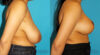 Breast Reduction case #7962 slider thumbnail