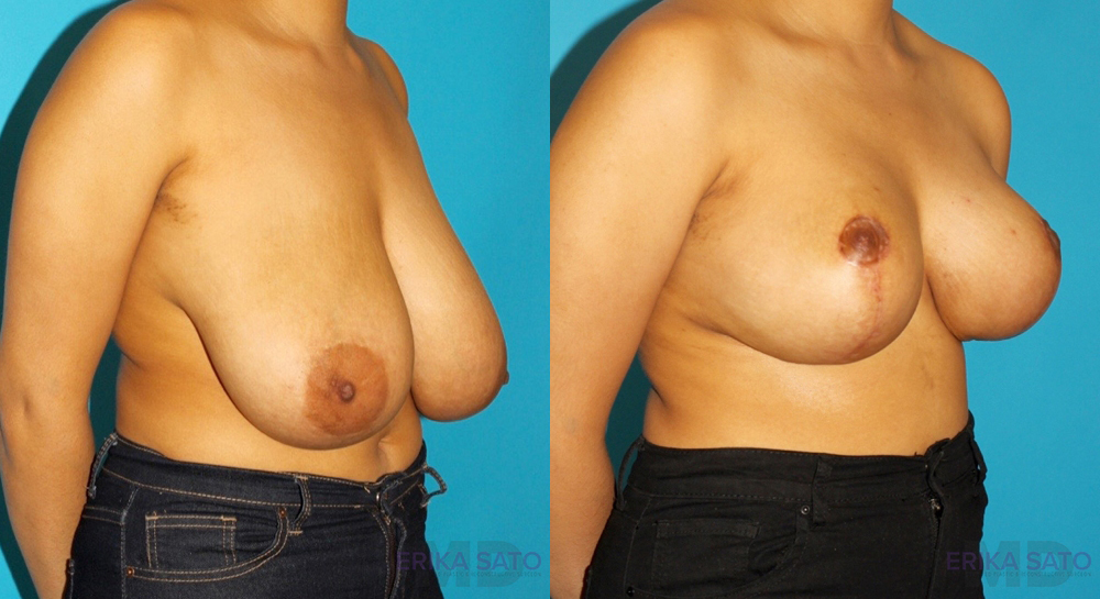 Breast Reduction case #7962