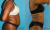 Liposuction case #5891 slider thumbnail