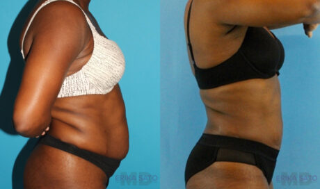 Liposuction case #5891