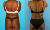 Liposuction case #5891 slider thumbnail