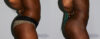 Brazilian Butt Lift case #4417 slider thumbnail