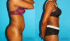 Tummy Tuck case #7275 slider thumbnail