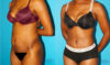 Tummy Tuck case #7275 slider thumbnail