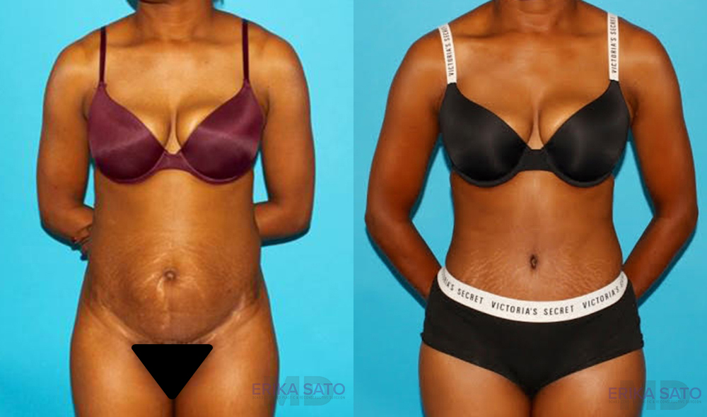 Tummy Tuck case #7275