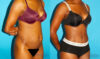 Tummy Tuck case #7275 slider thumbnail
