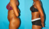 Tummy Tuck case #7275 slider thumbnail