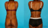 Tummy Tuck case #7275 slider thumbnail