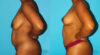 Breast Lift case #6994 slider thumbnail