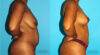 Breast Lift case #6994 slider thumbnail