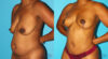 Breast Lift case #6994 slider thumbnail