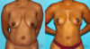 Breast Lift case #6994 slider thumbnail