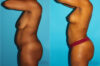 Brazilian Butt Lift case #4605 slider thumbnail