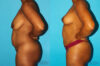 Brazilian Butt Lift case #4605 slider thumbnail