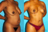 Brazilian Butt Lift case #4605 slider thumbnail