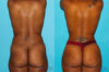 Brazilian Butt Lift case #4605 slider thumbnail