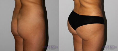 Brazilian Butt Lift case #4408