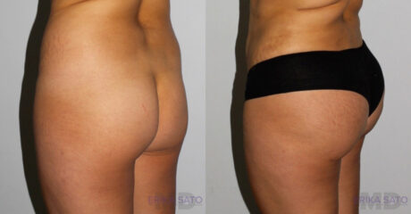 Brazilian Butt Lift case #4408