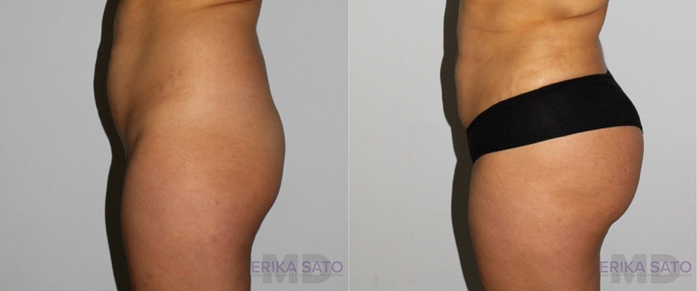 Brazilian Butt Lift case #4408