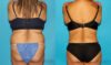 Tummy Tuck case #7170 slider thumbnail